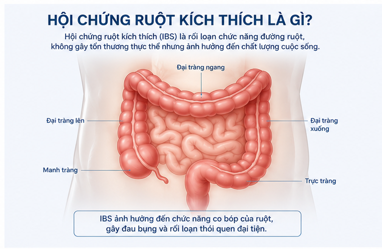 ảnh mô tả hội chứng ruột kích thích